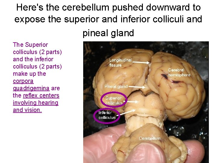 Here's the cerebellum pushed downward to expose the superior and inferior colliculi and pineal