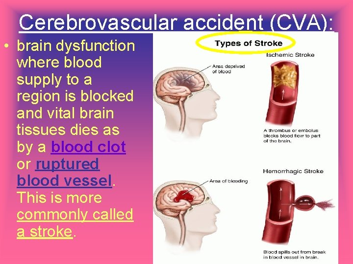 Cerebrovascular accident (CVA): • brain dysfunction where blood supply to a region is blocked