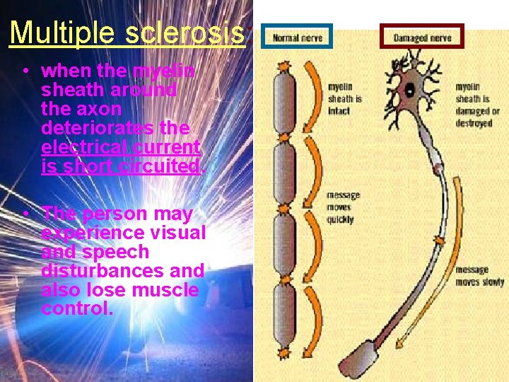 Multiple sclerosis: • when the myelin sheath around the axon deteriorates the electrical current