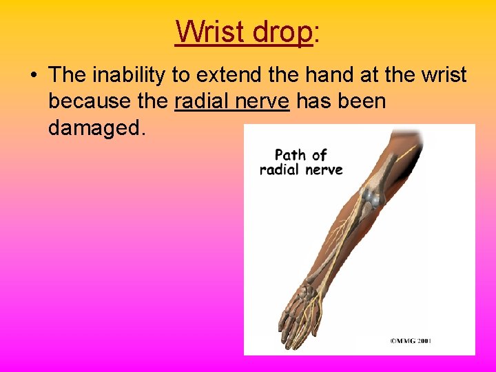 Wrist drop: • The inability to extend the hand at the wrist because the