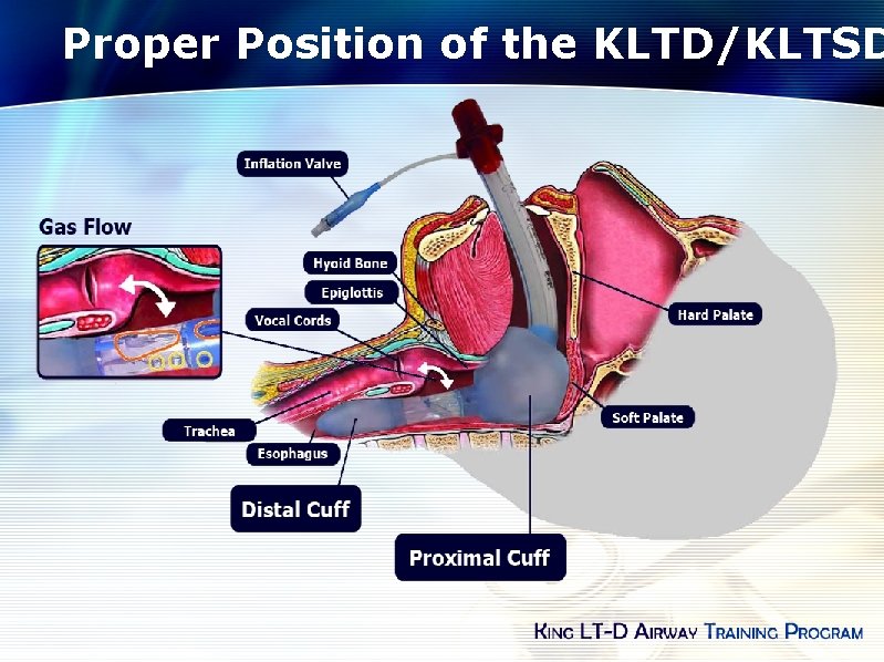 Proper Position of the KLTD/KLTSD 