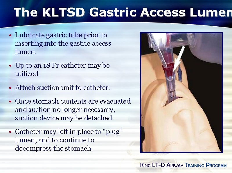 The KLTSD Gastric Access Lumen • Lubricate gastric tube prior to inserting into the