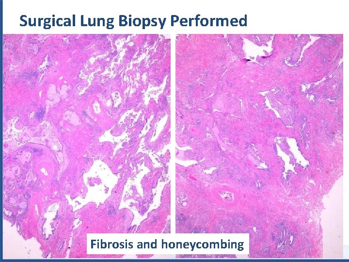 Surgical Lung Biopsy Performed Fibrosis and honeycombing 