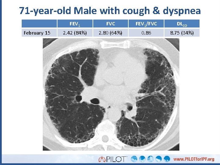 71 -year-old Male with cough & dyspnea February 15 FEV 1 FVC FEV 1/FVC