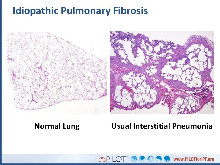 Idiopathic Pulmonary Fibrosis Normal Lung Usual Interstitial Pneumonia 