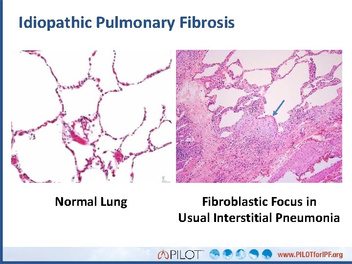 Idiopathic Pulmonary Fibrosis Normal Lung Fibroblastic Focus in Usual Interstitial Pneumonia 