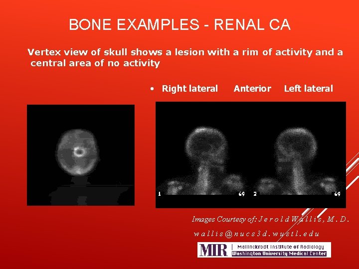 BONE EXAMPLES - RENAL CA Vertex view of skull shows a lesion with a