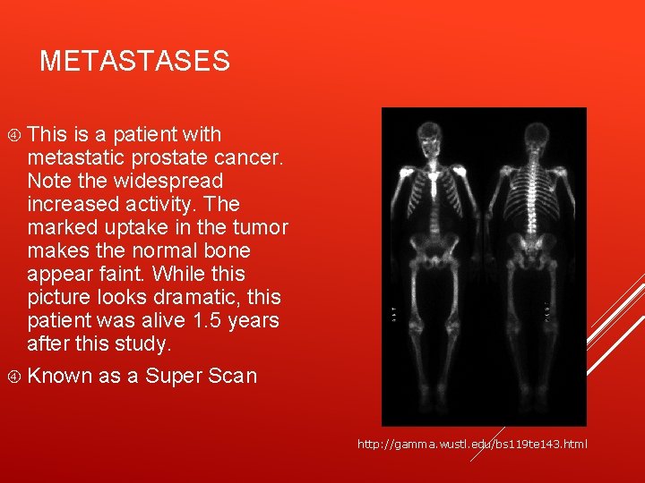 METASTASES This is a patient with metastatic prostate cancer. Note the widespread increased activity.