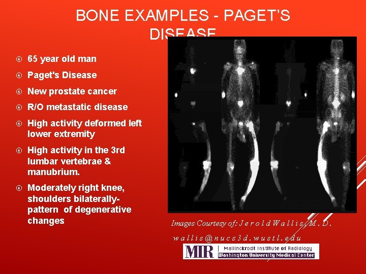 BONE EXAMPLES - PAGET’S DISEASE 65 year old man Paget's Disease New prostate cancer