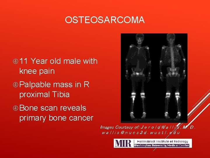 OSTEOSARCOMA 11 Year old male with knee pain Palpable mass in R proximal Tibia
