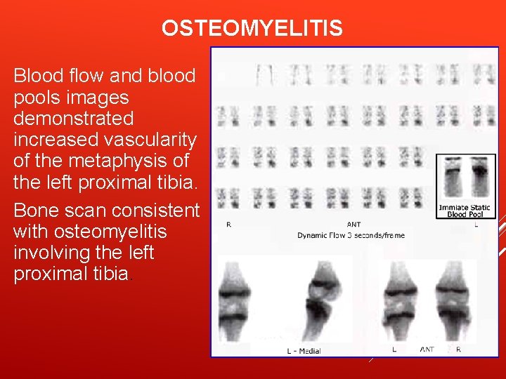 OSTEOMYELITIS Blood flow and blood pools images demonstrated increased vascularity of the metaphysis of