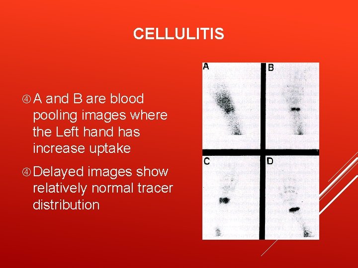 CELLULITIS A and B are blood pooling images where the Left hand has increase