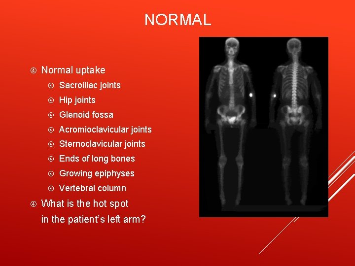 NORMAL Normal uptake Sacroiliac joints Hip joints Glenoid fossa Acromioclavicular joints Sternoclavicular joints Ends