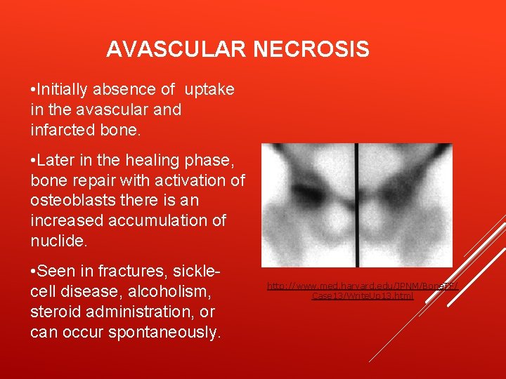 AVASCULAR NECROSIS • Initially absence of uptake in the avascular and infarcted bone. •