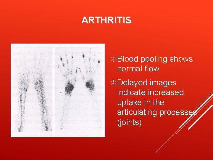 ARTHRITIS Blood pooling shows normal flow Delayed images indicate increased uptake in the articulating