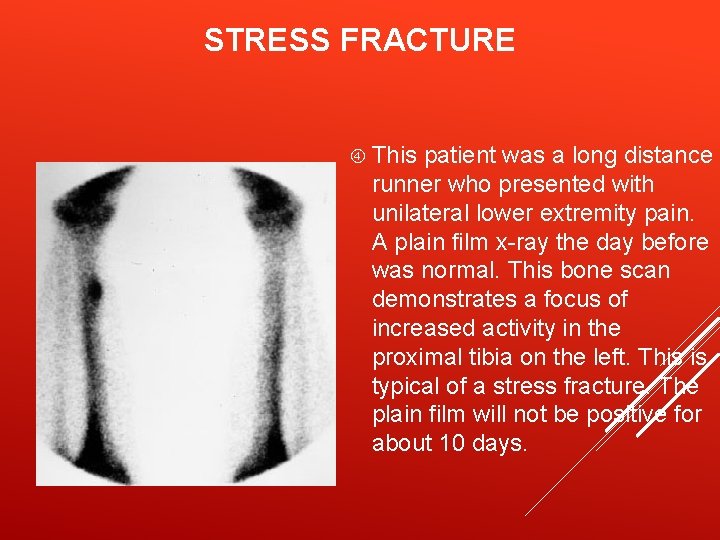 STRESS FRACTURE This patient was a long distance runner who presented with unilateral lower