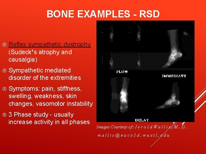 BONE EXAMPLES - RSD Reflex sympathetic dystrophy (Sudeck¹s atrophy and causalgia) Sympathetic mediated disorder
