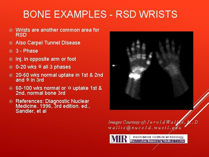 BONE EXAMPLES - RSD WRISTS Wrists are another common area for RSD Also Carpel