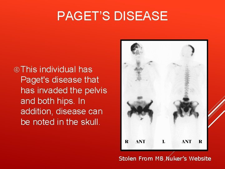 PAGET’S DISEASE This individual has Paget's disease that has invaded the pelvis and both