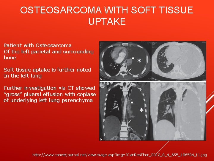 OSTEOSARCOMA WITH SOFT TISSUE UPTAKE Patient with Osteosarcoma Of the left parietal and surrounding