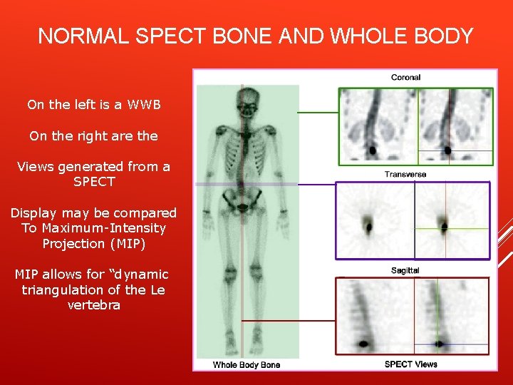 NORMAL SPECT BONE AND WHOLE BODY On the left is a WWB On the