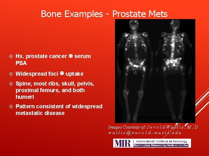 Bone Examples - Prostate Mets Hx. prostate cancer serum PSA Widespread foci uptake Spine,