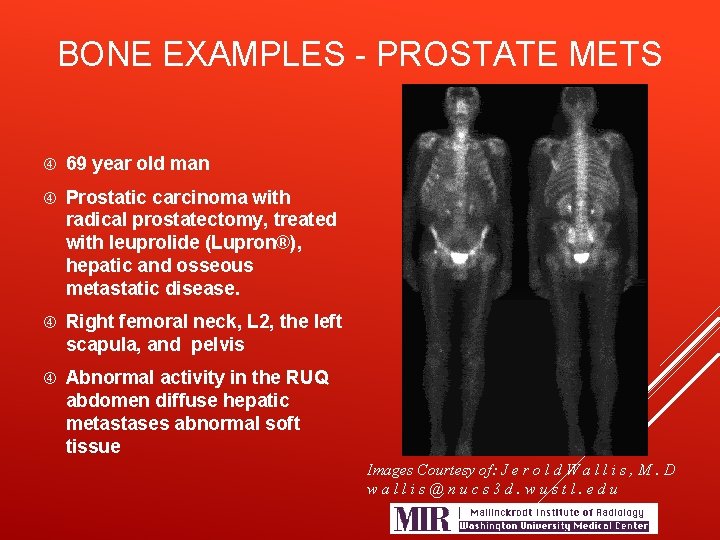 BONE EXAMPLES - PROSTATE METS 69 year old man Prostatic carcinoma with radical prostatectomy,