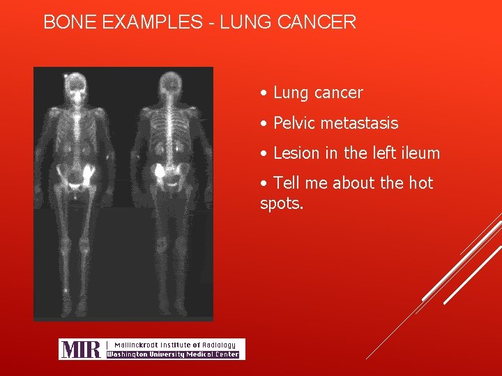 BONE EXAMPLES - LUNG CANCER • Lung cancer • Pelvic metastasis • Lesion in