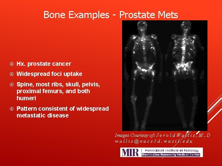 Bone Examples - Prostate Mets Hx. prostate cancer Widespread foci uptake Spine, most ribs,