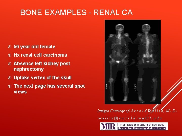 BONE EXAMPLES - RENAL CA 59 year old female Hx renal cell carcinoma Absence