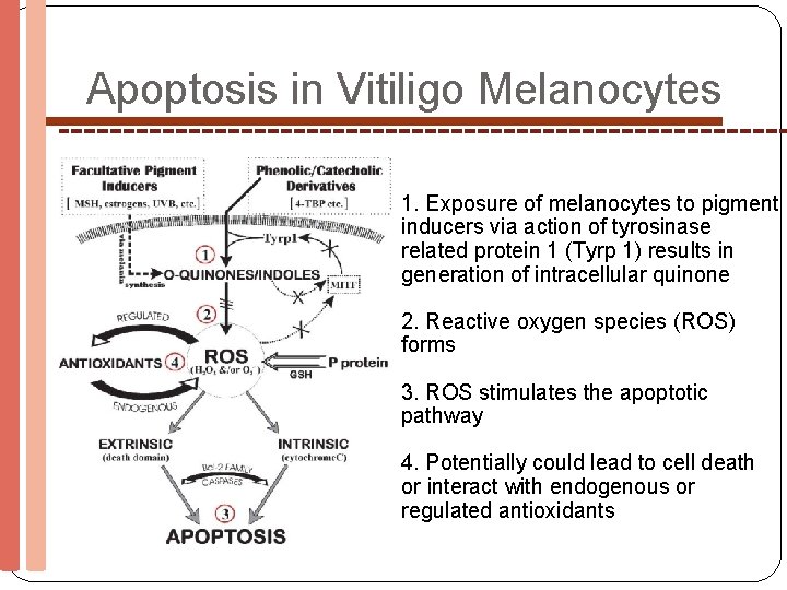 Apoptosis in Vitiligo Melanocytes 1. Exposure of melanocytes to pigment inducers via action of