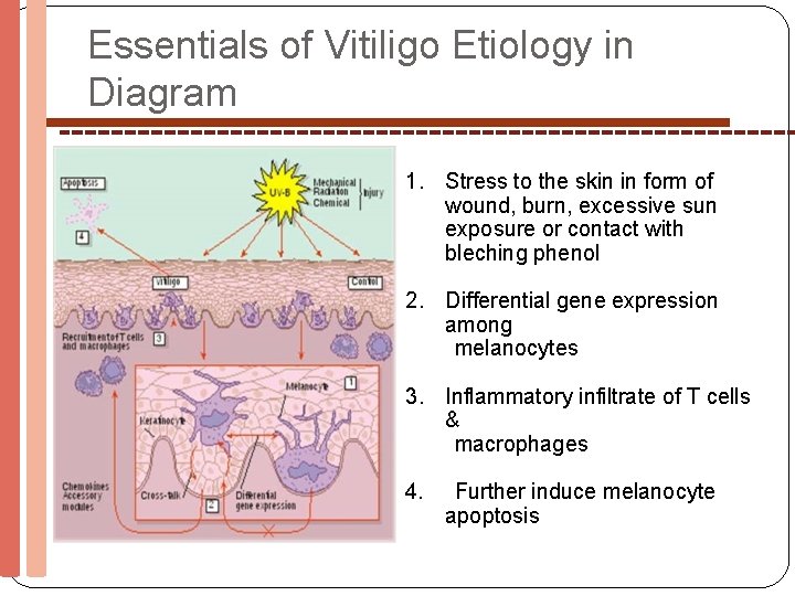Essentials of Vitiligo Etiology in Diagram 1. Stress to the skin in form of