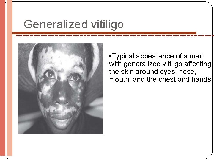 Generalized vitiligo • Typical appearance of a man with generalized vitiligo affecting the skin