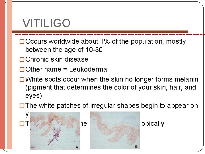 VITILIGO � Occurs worldwide about 1% of the population, mostly between the age of