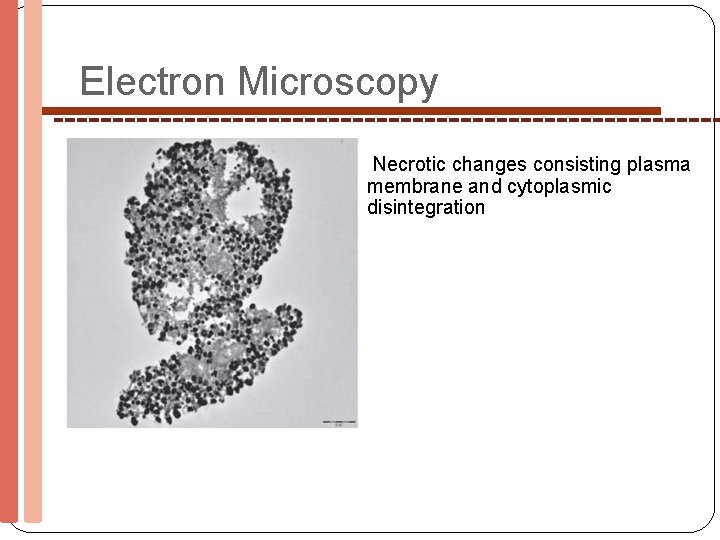 Electron Microscopy Necrotic changes consisting plasma membrane and cytoplasmic disintegration 