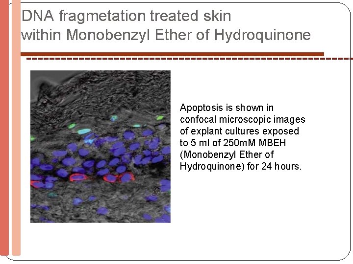 DNA fragmetation treated skin within Monobenzyl Ether of Hydroquinone Apoptosis is shown in confocal