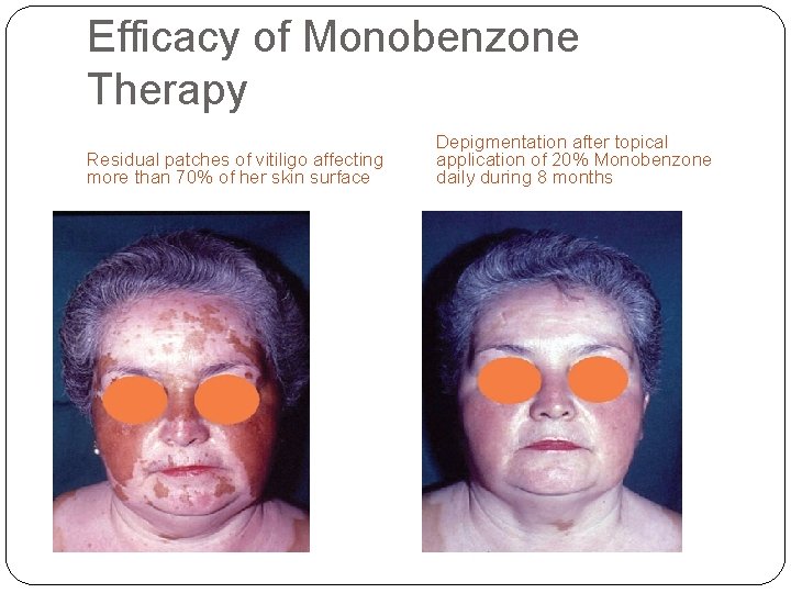 Efficacy of Monobenzone Therapy Residual patches of vitiligo affecting more than 70% of her