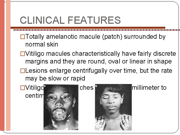 CLINICAL FEATURES �Totally amelanotic macule (patch) surrounded by normal skin �Vitiligo macules characteristically have