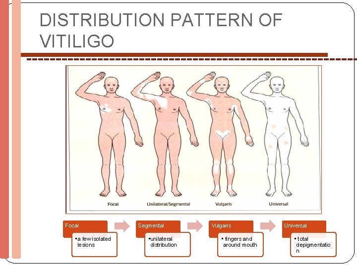 DISTRIBUTION PATTERN OF VITILIGO Focal • a few isolated lesions Segmental • unilateral distribution