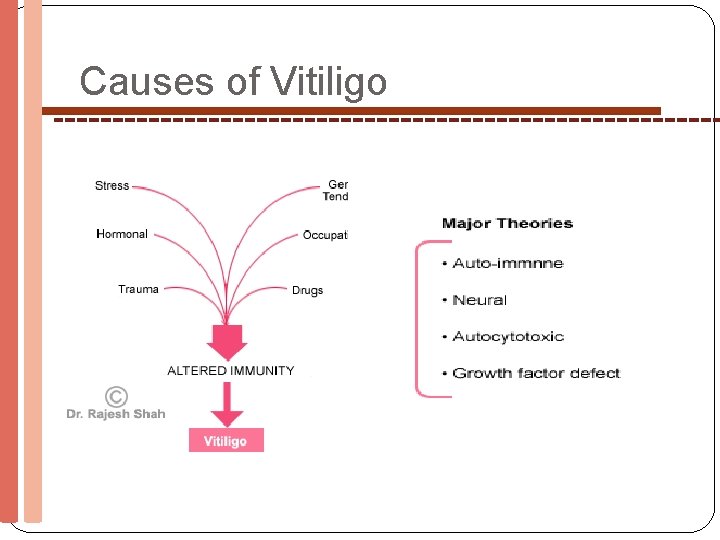 Causes of Vitiligo 