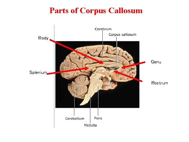 Parts of Corpus Callosum Body Genu Splenium Rostrum 