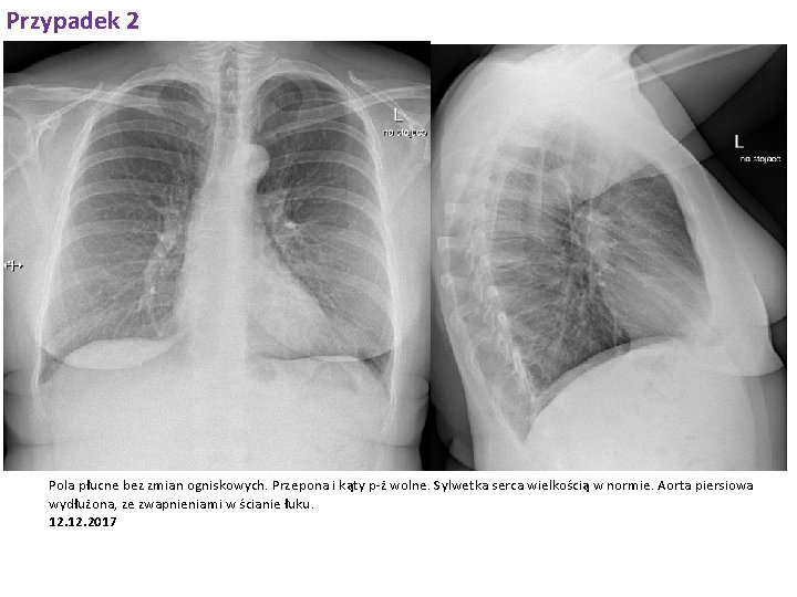 Przypadek 2 Pola płucne bez zmian ogniskowych. Przepona i kąty p-ż wolne. Sylwetka serca