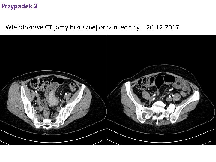 Przypadek 2 Wielofazowe CT jamy brzusznej oraz miednicy. 20. 12. 2017 