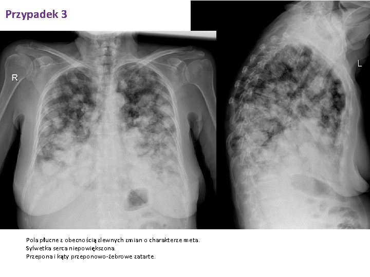 Przypadek 3 Pola płucne z obecnością zlewnych zmian o charakterze meta. Sylwetka serca niepowiększona.