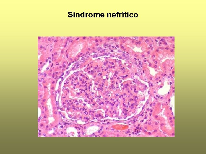 Sindrome nefrítico 