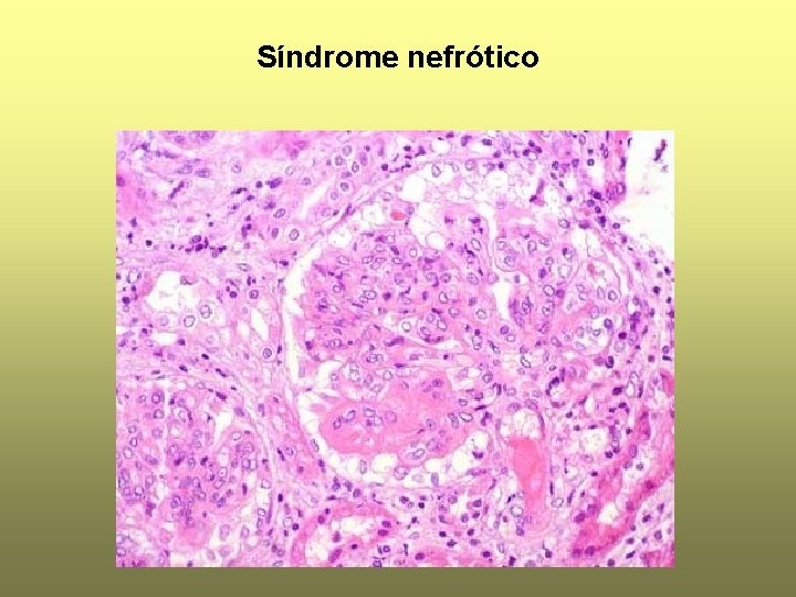 Síndrome nefrótico 