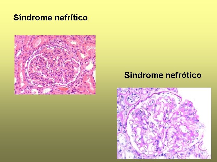 Síndrome nefrítico Síndrome nefrótico 