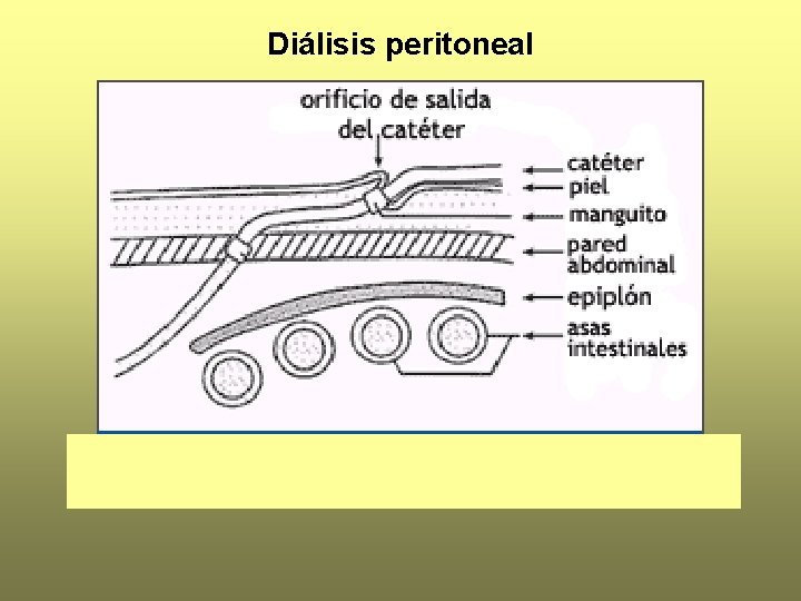 Diálisis peritoneal 