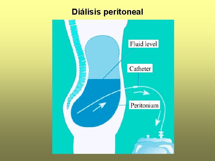 Diálisis peritoneal 