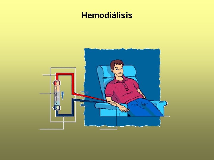 Hemodiálisis 